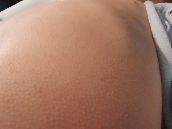Is this eczema?