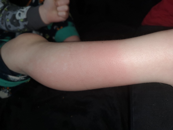 Rash