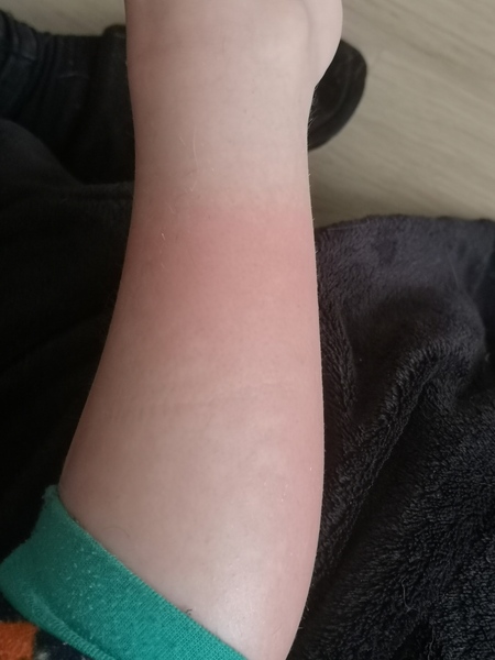 Rash