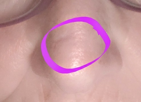 If anyone has had a punch biopsy (on the nose)...