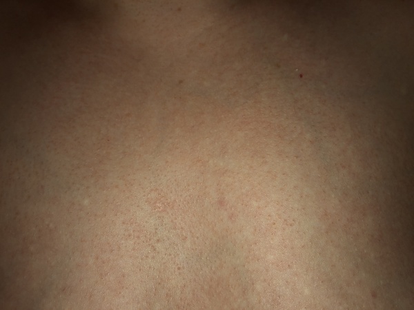 Can anyone advise me on my chest skin (with non-dodgy pics)