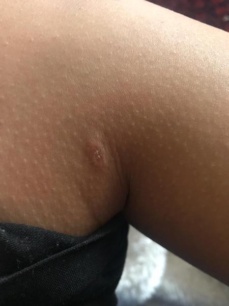 What could this rash be - pic attached?