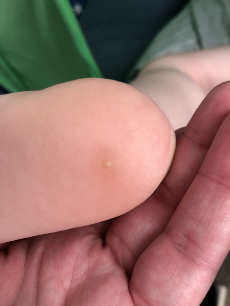 What is this watt or callus?