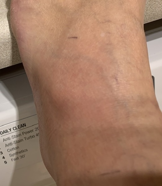 Any thoughts on what’s going on with my foot?