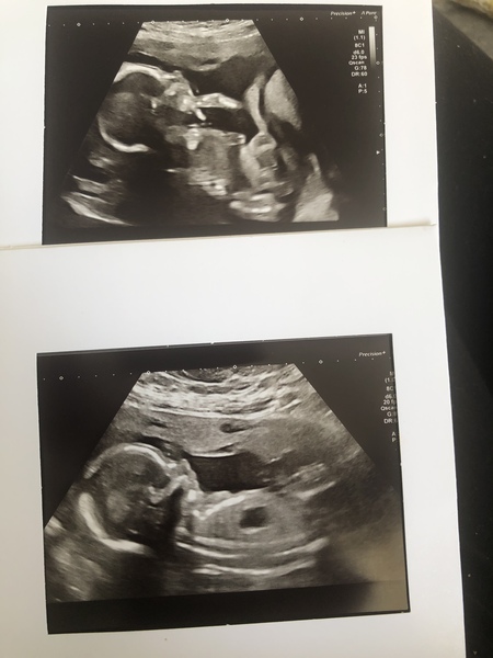 This is a girl isn’t it? 20 week scan.