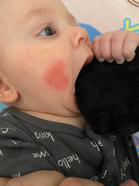 Red patch on baby's face. Need Dr or nurse advice