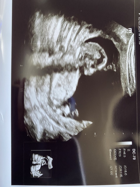 The wait to the 20 week scan-anyone else?