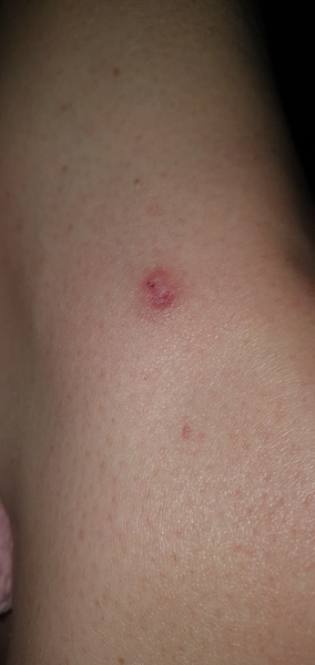 Warts and apple cider vinegar, now I have a white kneehole !