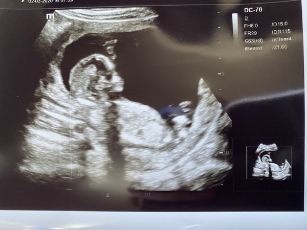 Boy or girl 14 weeks ?