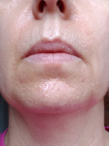 Feeling Rubbish with my rubbish skin!