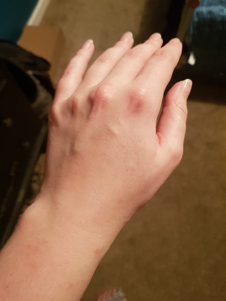 Broken out in spots over upper body?!