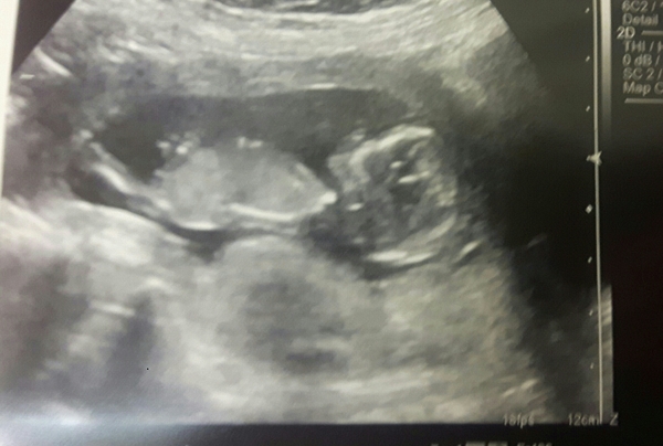 Skull/nub theory - any guesses please