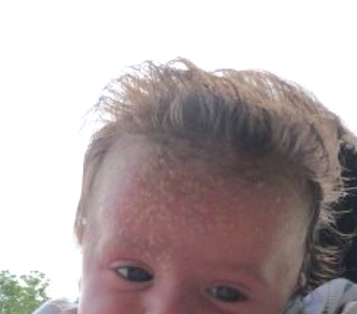 Cradle Cap Tips