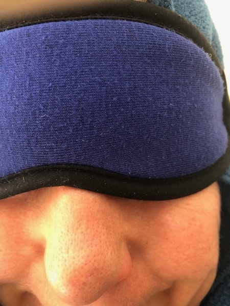 Blackhead and spot scarring