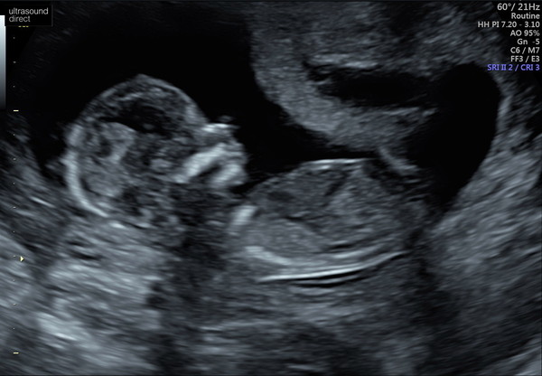 Pregnant after loss and dreaming of rainbows - 2