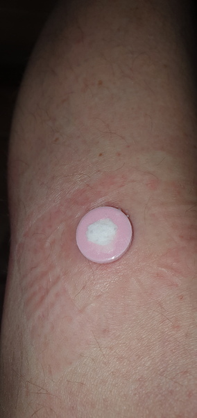 Warts and apple cider vinegar, now I have a white kneehole !