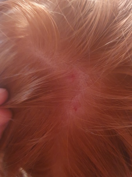 To be really worried about spot on DD's scalp?