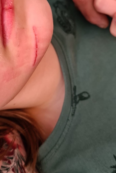 DD has split her face. Can I use stristrips. Warning photo