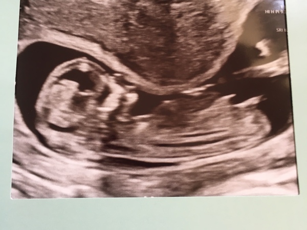Pregnant again after an ectopic freaking out!!