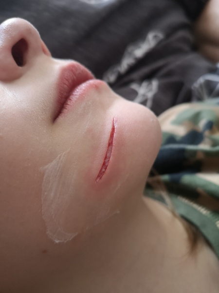 DD has split her face. Can I use stristrips. Warning photo