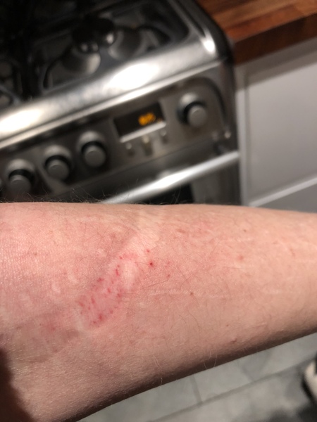 I think I have the oddest injury ever, do I win a prize?