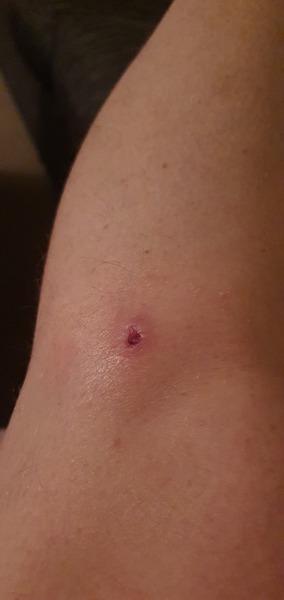 Warts and apple cider vinegar, now I have a white kneehole !
