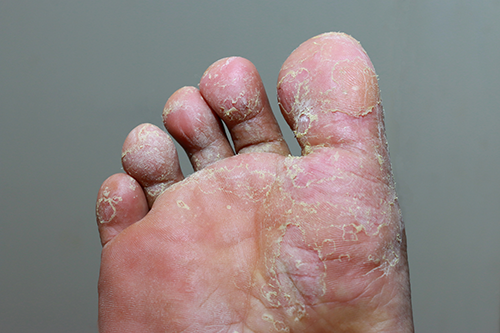 Dry splitting skin on toes
