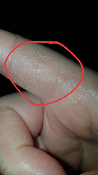 What are the most stupid injuries you’ve had?