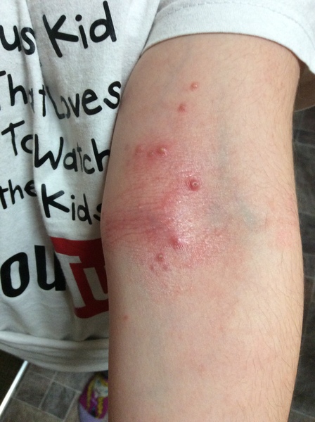 Molluscum