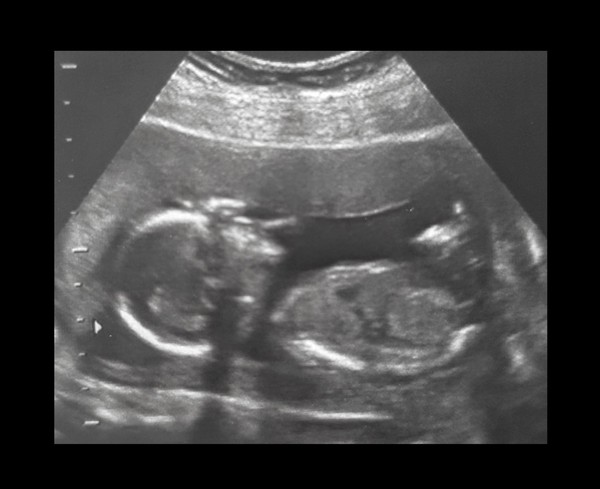 Scan at 17 weeks