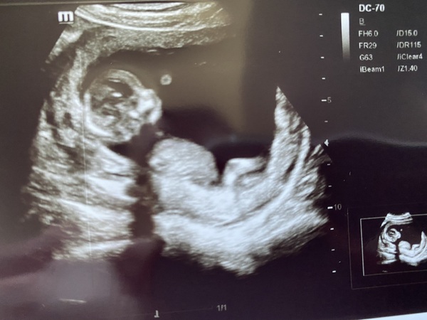 Boy or girl? Skull theory?