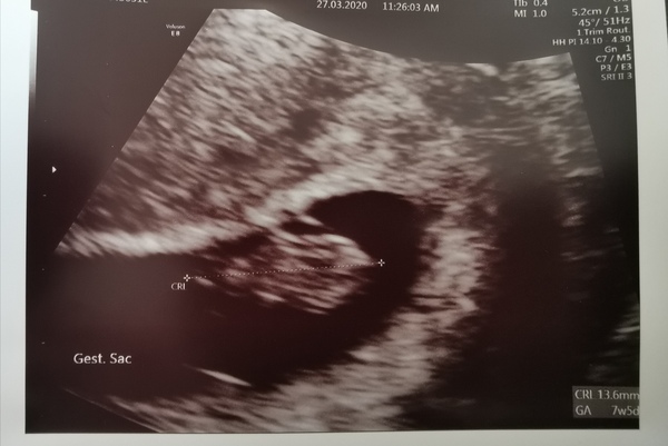 Waiting club for 12 week scan