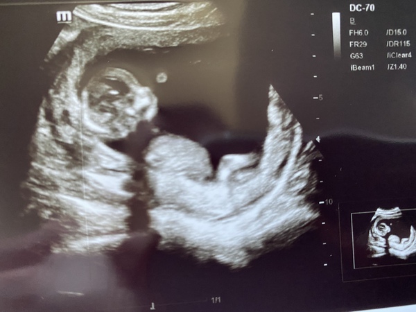 Gender scan tomorrow-guesses just for fun ?