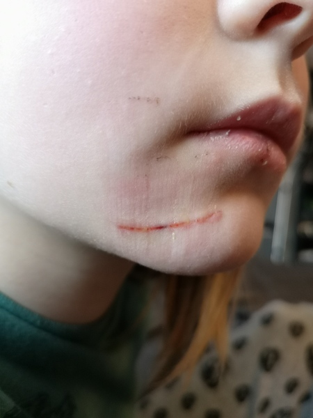 DD has split her face. Can I use stristrips. Warning photo