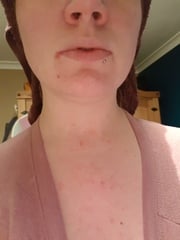Broken out in spots over upper body?!