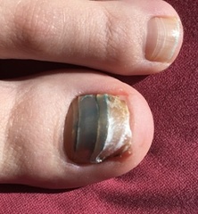 Does anyone know anything about toenails (disgusting picture alert!)