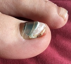 Does anyone know anything about toenails (disgusting picture alert!)