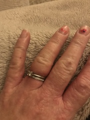 Anyone advise on stuck ring/swollen finger?