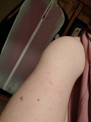 Broken out in spots over upper body?!