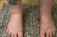 Swollen feet and hands - do I get checked out tonight or wait until next appointment?
