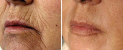No wrinkles at 42?