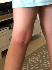 Any idea about this rash/soreness?