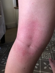 Any idea about this rash/soreness?