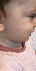 Fever for two days now this weird face rash. Any ideas?