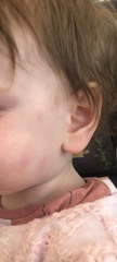 Fever for two days now this weird face rash. Any ideas?