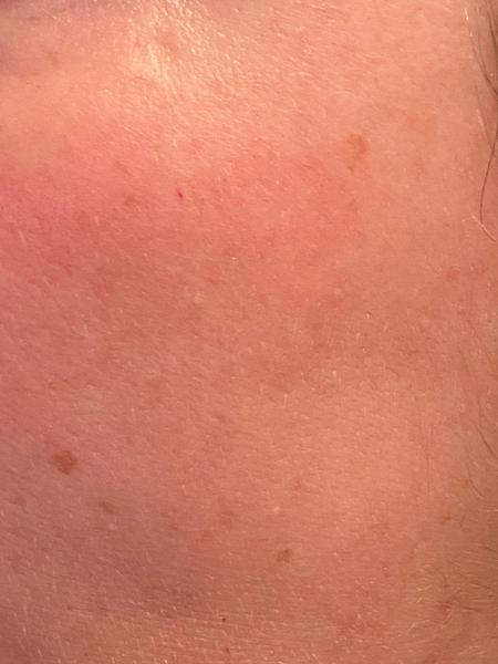 How to even out this skin tone?