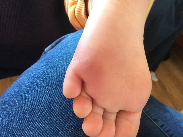 puncture wound? advice needed (photos)