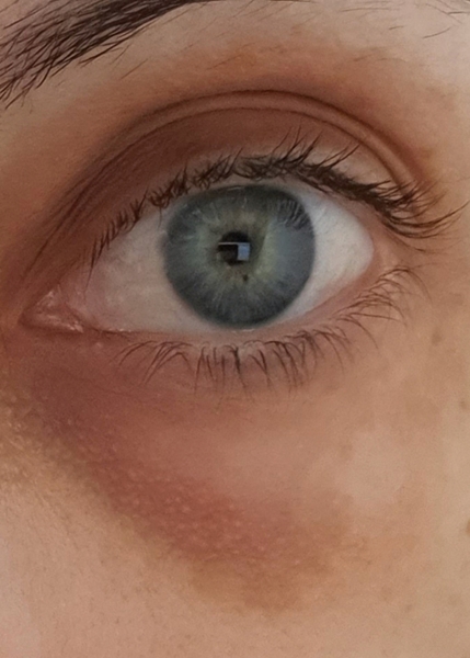 Hate my eye bags and dark circles (pic)