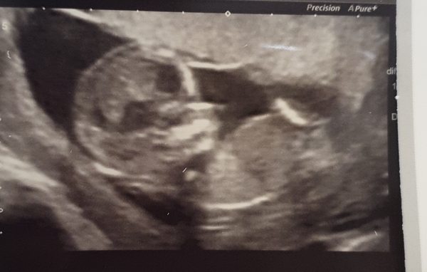 Pregnant after loss and dreaming of rainbows - 2