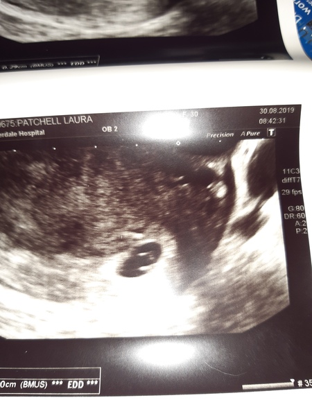 IVF Viability Scan / Coronavirus worries x